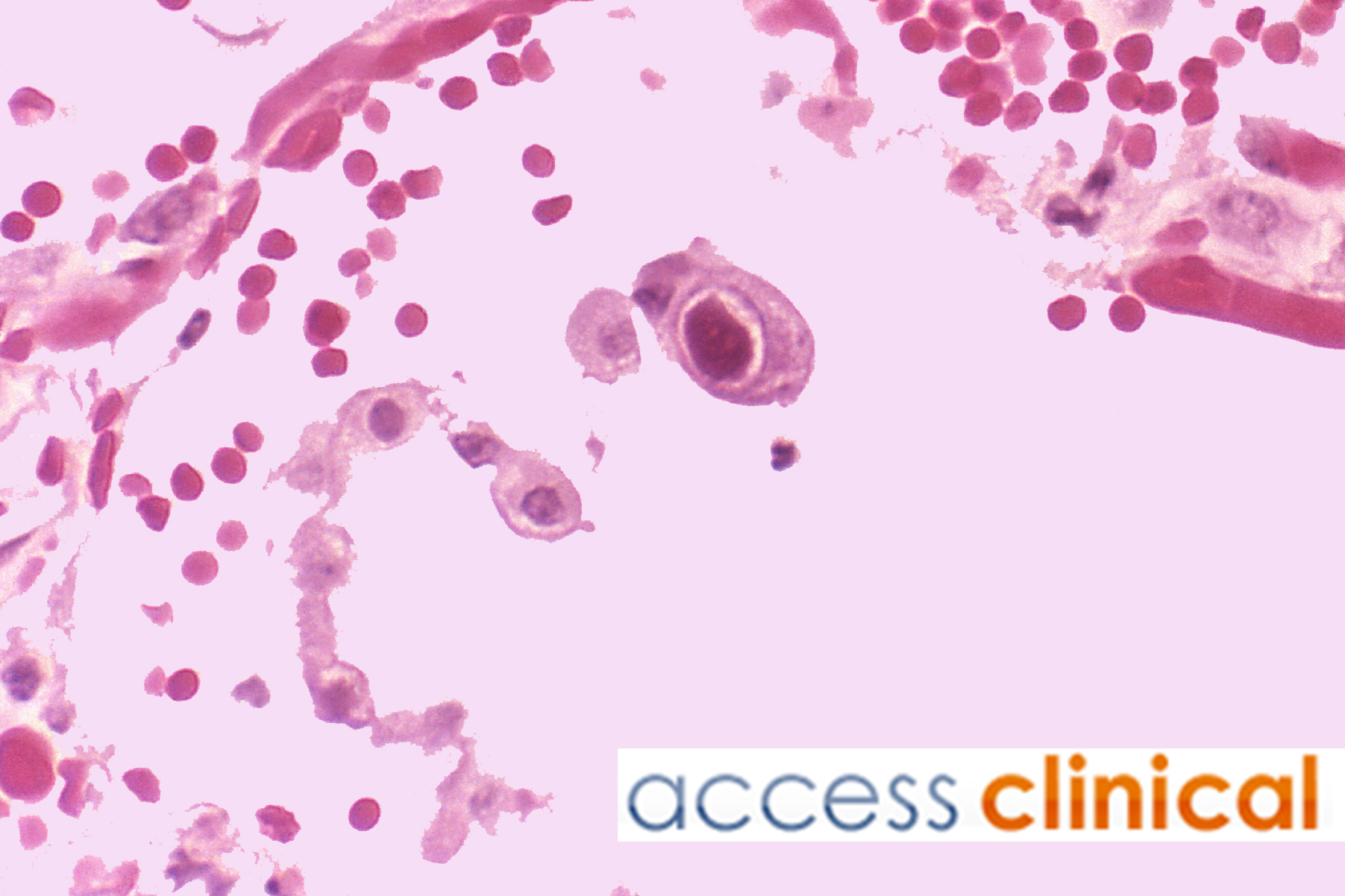 Is Cytomegalovirus Blood Donation easy | Access Clinical